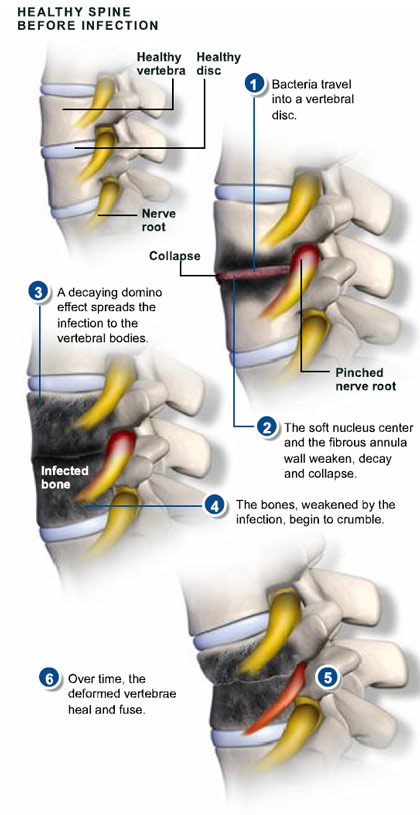 What are the signs of spinal infection?