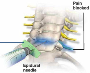 Caudal Epidural Technique