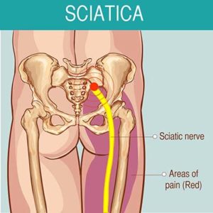 rapidly relieve sciatica