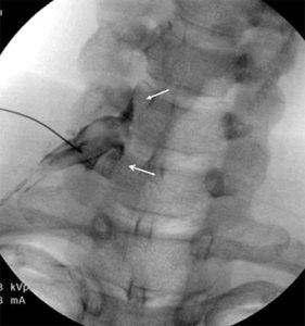 selective Nerve Root Block