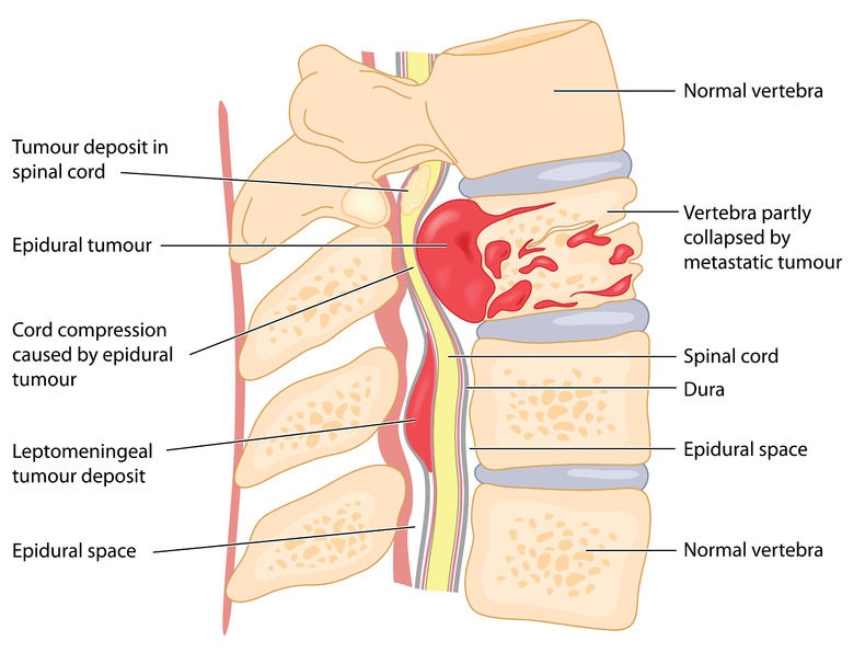 Treating cancer of the spine