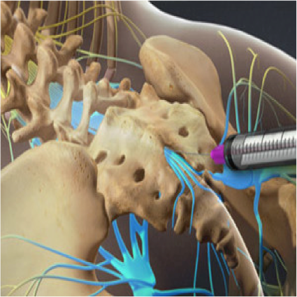 Caudal Epidural Technique