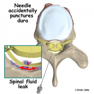 Risks of spinal injections