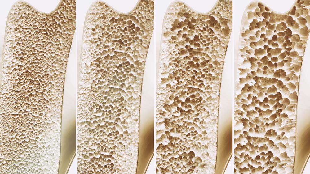 How to diagnose osteoporosis?