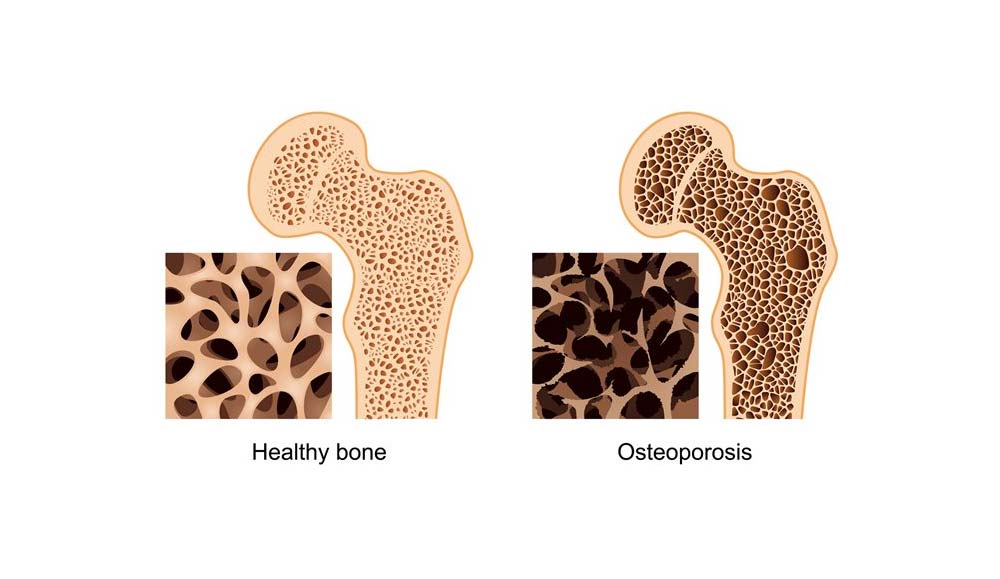 Why did I develop Osteoporosis?