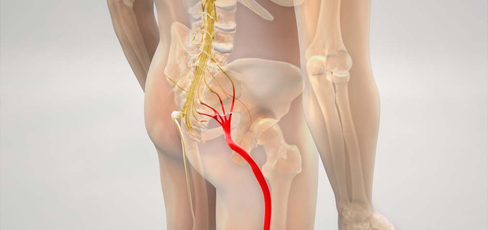 5 ways to rapidly relieve sciatica