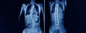 scoliosis X-ray