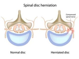 signs of cancer in back pain