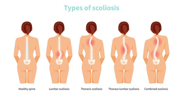 Type of scoliosis