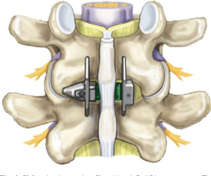 Surgical treatment of spinal stenosis