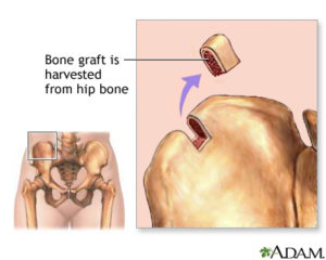 What is bone graft