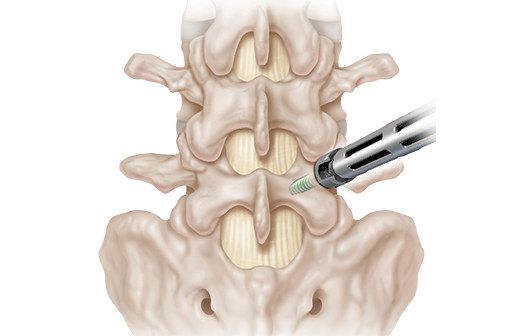 What is a Transforaminal Lumbar Interbody Fusion (TLIF)?