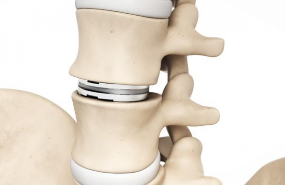 How is cervical disc replacement surgery performed?