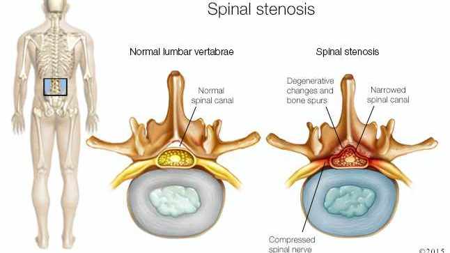 What is spinal stenosis