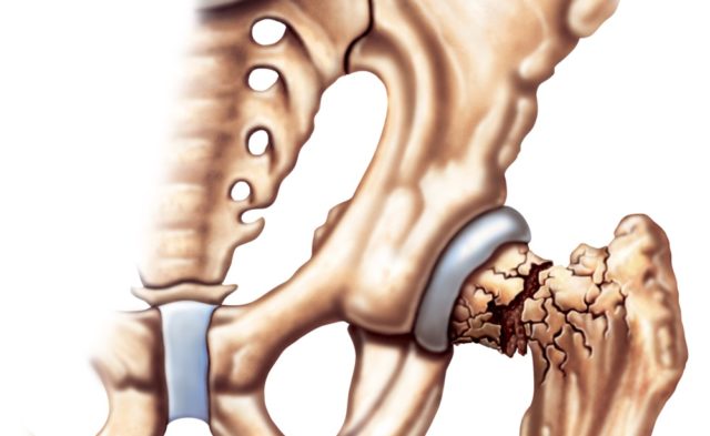 What are the risks of osteoporosis?