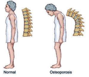 Complications of osteoporosis