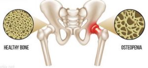 What is Osteopenia