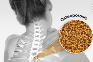 What is Osteoporosis?