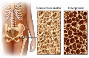 cause of osteopenia