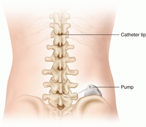  intrathecal drug delivery system