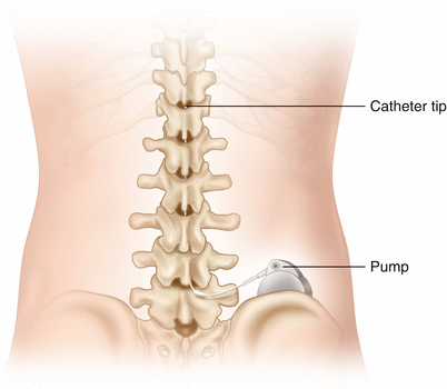 Intrathecal morphine combined with ropivacaine induces spinal myoclonus in cancer patients with an implanted intrathecal drug delivery system: Three case reports.