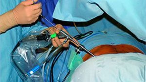 endoscopic discectomy