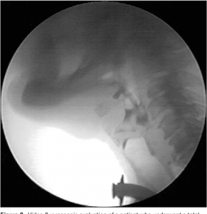 Fluoroscopic evaluation of the influence of needle gauge on epidural spread in caudal block.