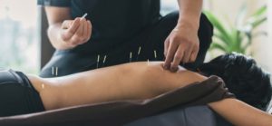 Acupuncture