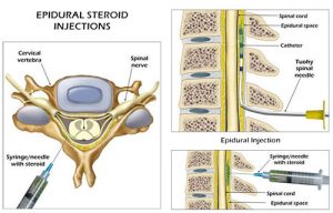  lumbar epidural steroid injections