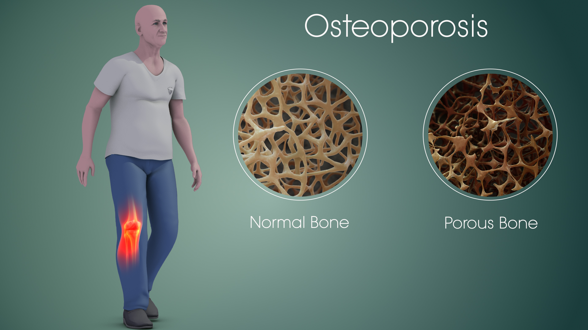 What is Osteoporosis?