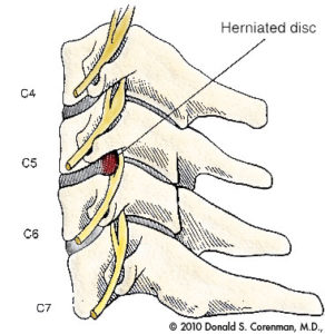 Cervical Disc Hernia