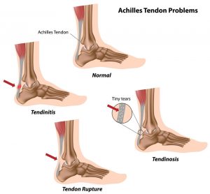 How can stem cells repair tendon injuries