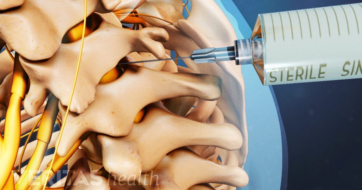 Effect of Injectate Viscosity on Epidural Distribution in Lumbar Transforaminal Epidural Steroid Injection.