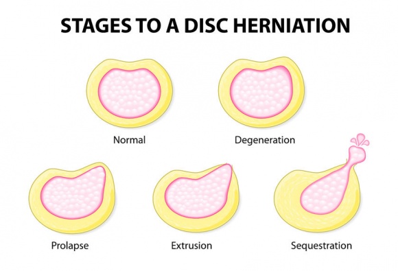 What is a disc prolapse?