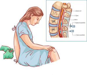 Radiation Dose Practice Audit of 6,234 Fluoroscopically-Guided Spinal Injections.