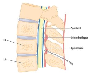 spinal injection