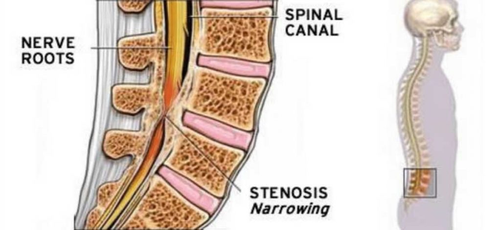 Lumbar Decompression