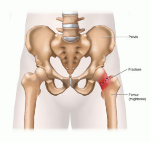  risks of osteoporosis