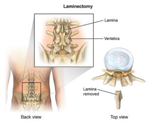 What is a laminectomy