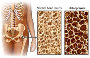  treat Osteoporosis