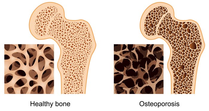 Complications of osteoporosis