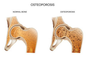 Early symptoms of osteoporosis