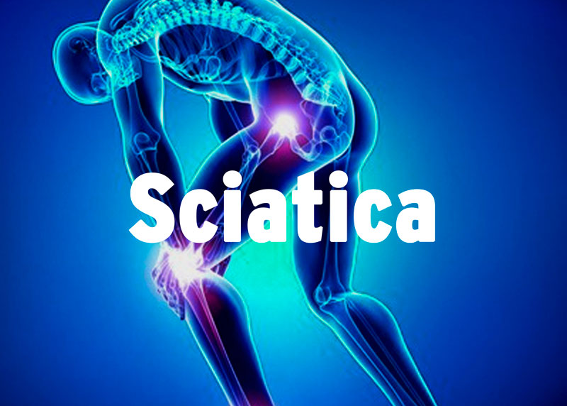 sciatica