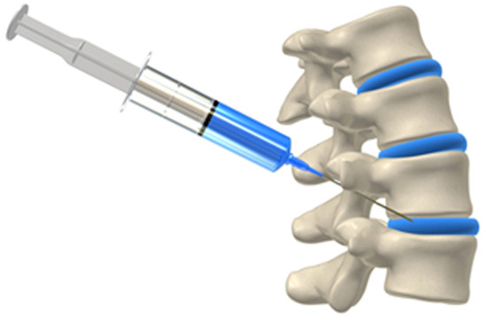 Radiation Dose Practice Audit of 6,234 Fluoroscopically-Guided Spinal Injections.