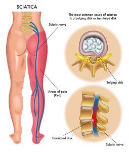 Which doctor should I see for my sciatica?