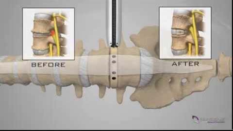 Extreme Lateral Lumbar Interbody Fusion XLIF