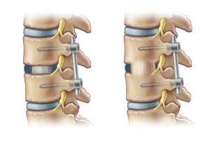 Transforaminal Lumbar Interbody Fusion (TLIF)